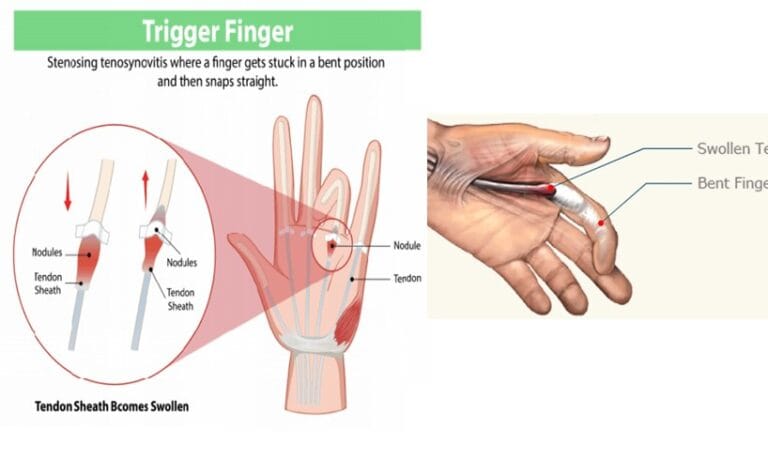 Trigger Finger: Jangan Biarkan Jari Anda Terkunci!